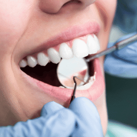 Diseño de Sonrisa con Carillas de porcelana ultra delgadas para un resultado natural y duradero. En bucaramanga, floridablaca, girón y piedecuesta